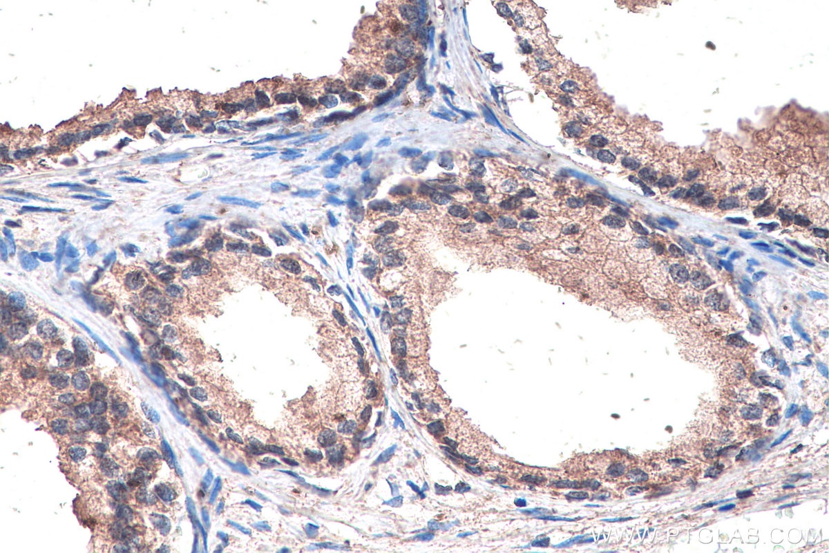 Immunohistochemistry (IHC) staining of human prostate cancer tissue using SMO Polyclonal antibody (20787-1-AP)