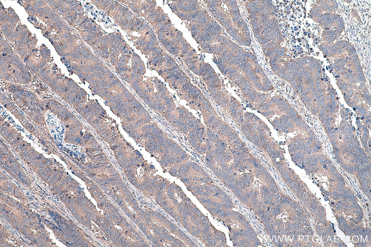 IHC staining of human colon cancer using 20787-1-AP