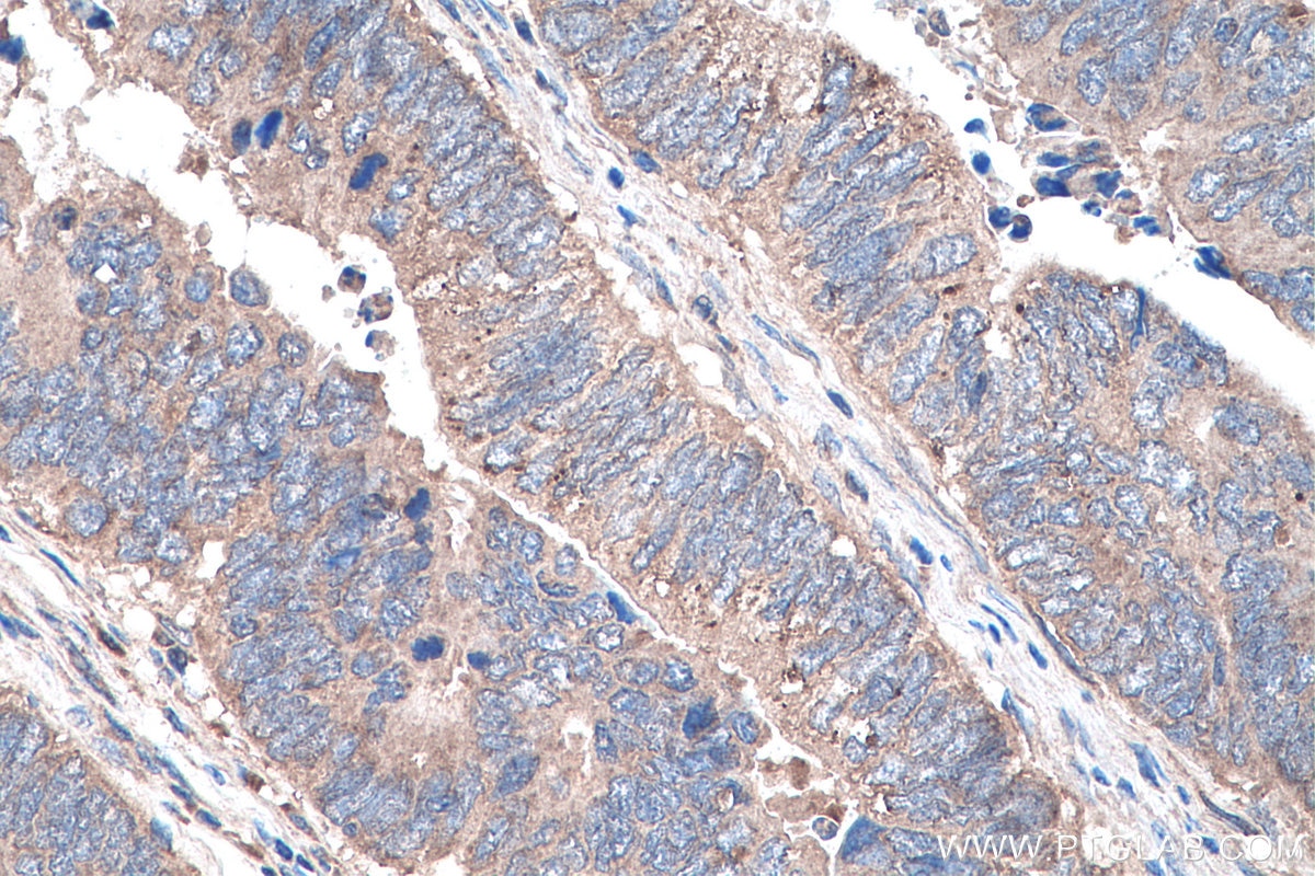 Immunohistochemistry (IHC) staining of human colon cancer tissue using SMO Polyclonal antibody (20787-1-AP)