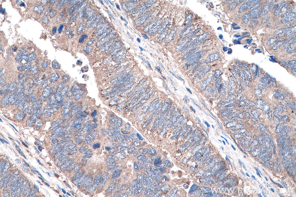 IHC staining of human colon cancer using 20787-1-AP