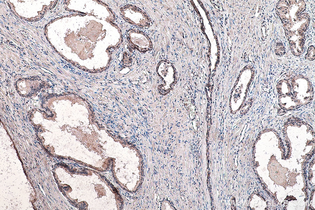 Immunohistochemistry (IHC) staining of human prostate cancer tissue using SMO Monoclonal antibody (66851-1-Ig)