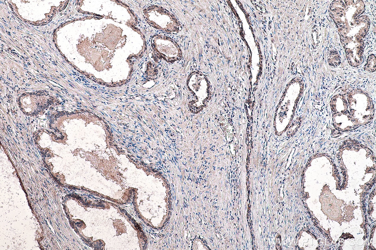 IHC staining of human prostate cancer using 66851-1-Ig