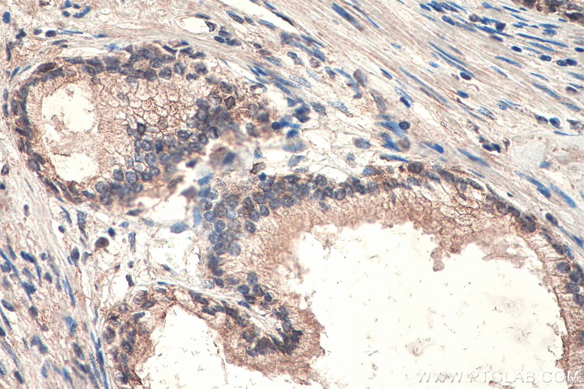 Immunohistochemistry (IHC) staining of human prostate cancer tissue using SMO Monoclonal antibody (66851-1-Ig)