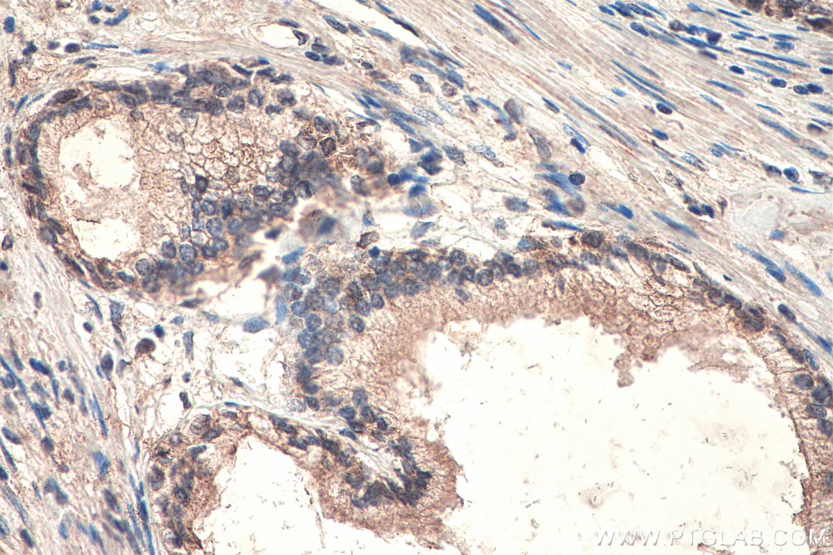 IHC staining of human prostate cancer using 66851-1-Ig