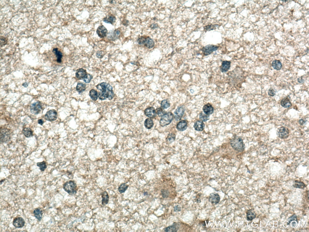 Immunohistochemistry (IHC) staining of human gliomas tissue using SMOX Polyclonal antibody (15052-1-AP)