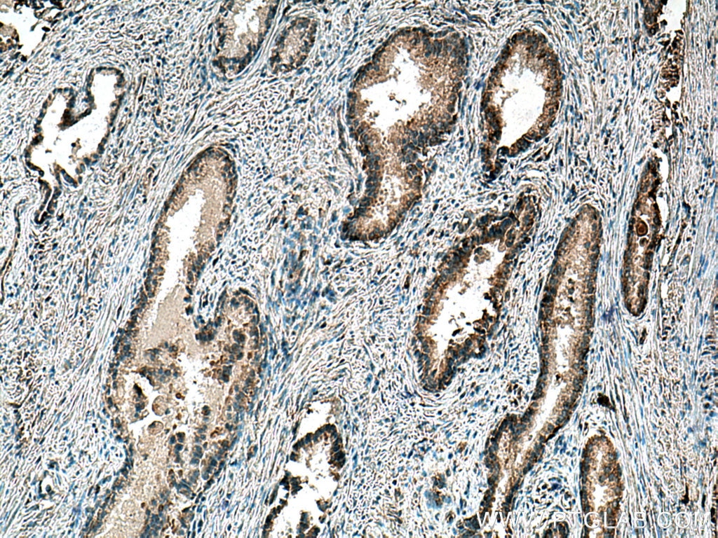Immunohistochemistry (IHC) staining of human prostate cancer tissue using SMOX Polyclonal antibody (15052-1-AP)