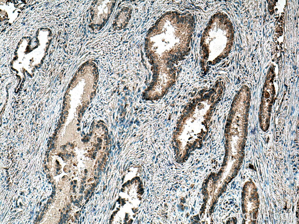 IHC staining of human prostate cancer using 15052-1-AP