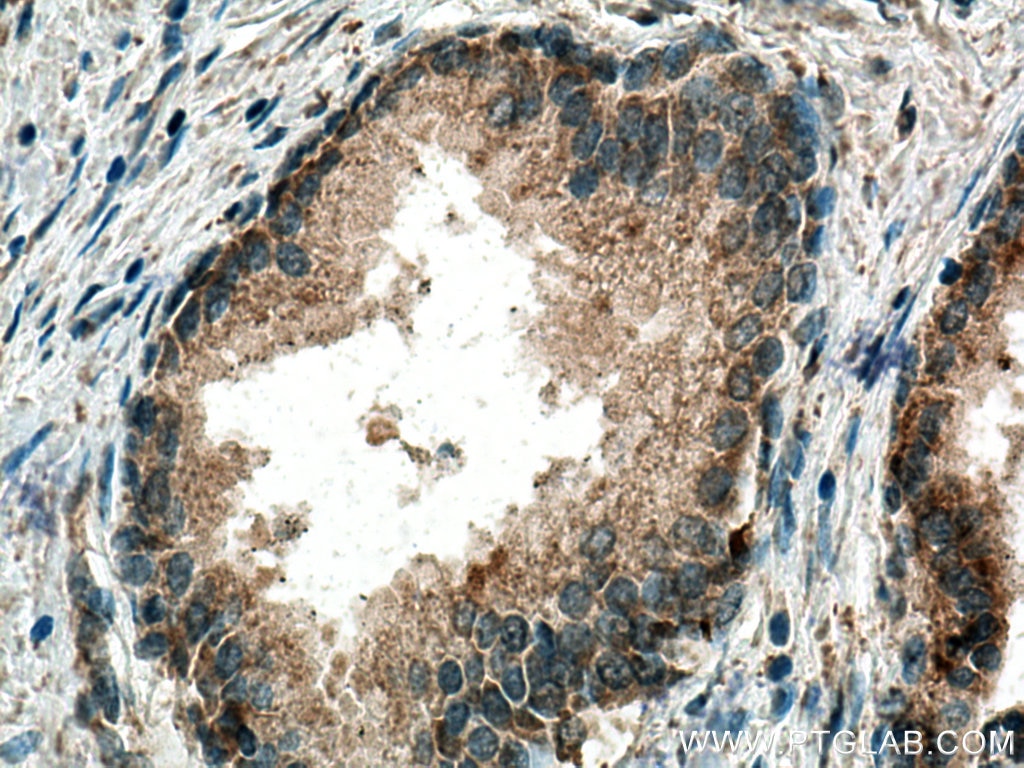 Immunohistochemistry (IHC) staining of human prostate cancer tissue using SMOX Polyclonal antibody (15052-1-AP)