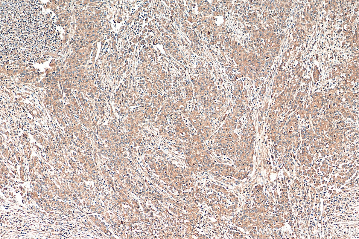 Immunohistochemistry (IHC) staining of human stomach cancer tissue using SMOX Polyclonal antibody (15052-1-AP)