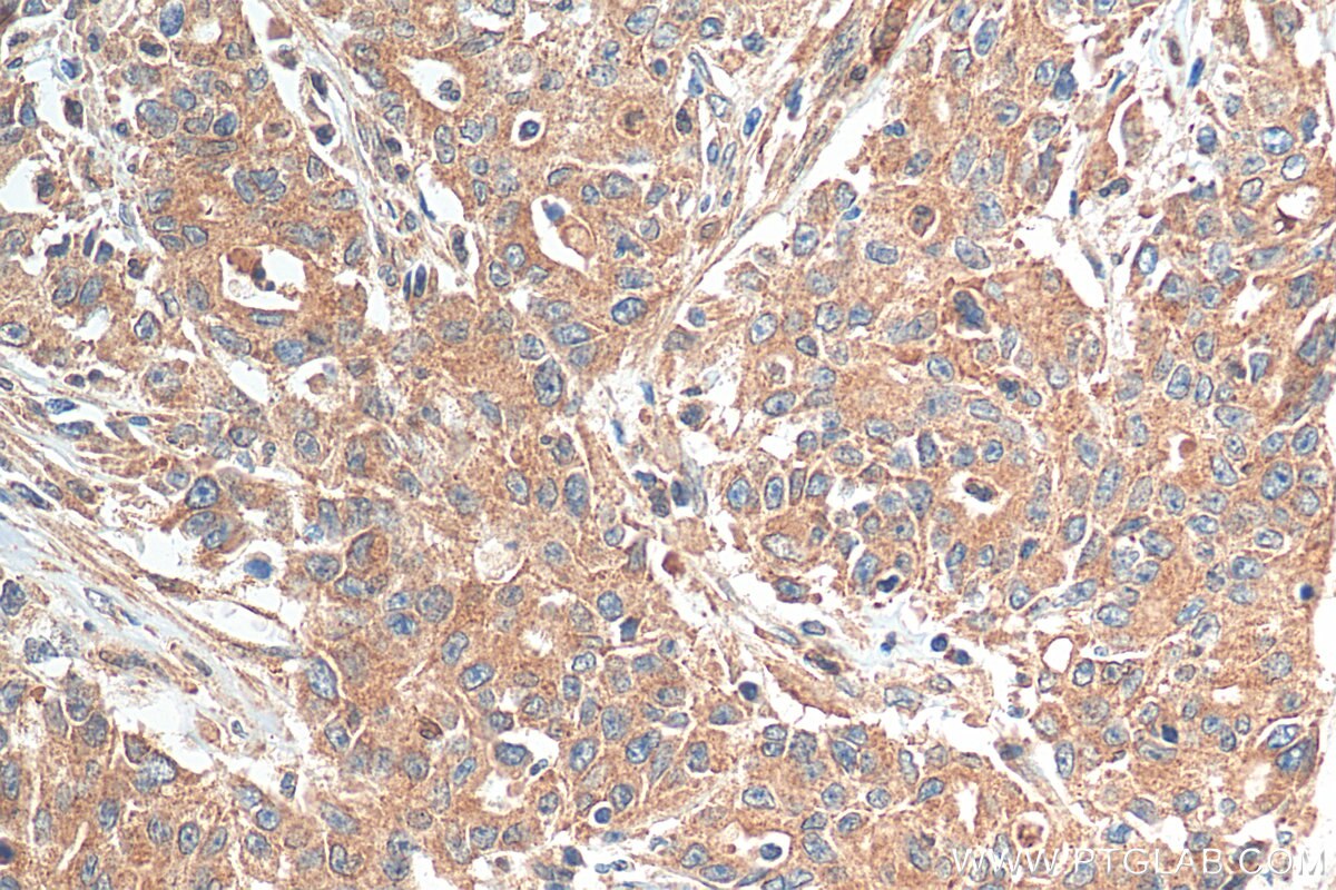 Immunohistochemistry (IHC) staining of human stomach cancer tissue using SMOX Polyclonal antibody (15052-1-AP)