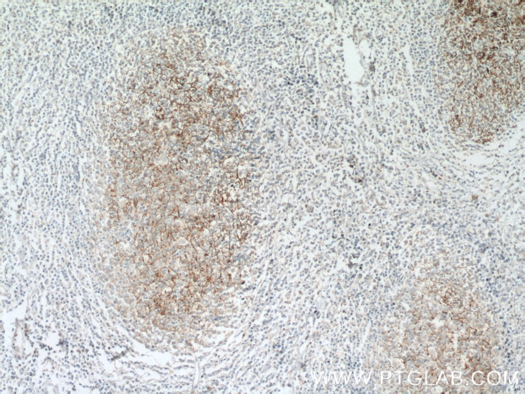 Immunohistochemistry (IHC) staining of human tonsillitis tissue using SMPD1,ASM Polyclonal antibody (14609-1-AP)