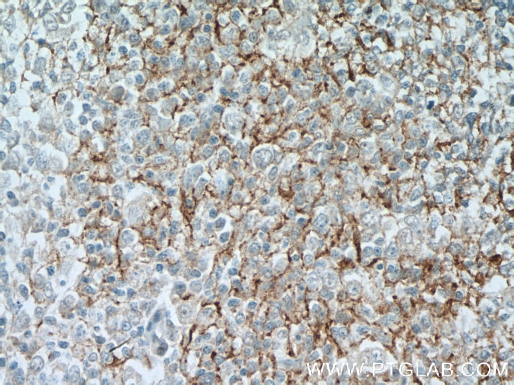 Immunohistochemistry (IHC) staining of human tonsillitis tissue using SMPD1,ASM Polyclonal antibody (14609-1-AP)