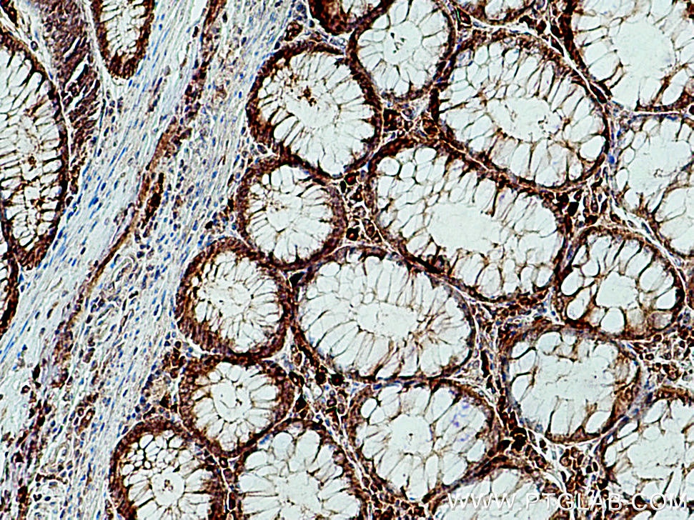 IHC staining of human colon cancer using 16552-1-AP