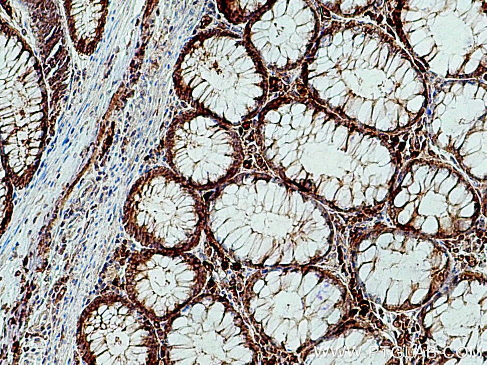 Immunohistochemistry (IHC) staining of human colon cancer tissue using SMPDL3B Polyclonal antibody (16552-1-AP)