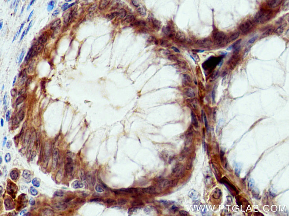 Immunohistochemistry (IHC) staining of human colon cancer tissue using SMPDL3B Polyclonal antibody (16552-1-AP)