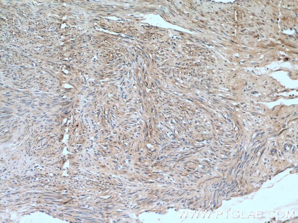 Immunohistochemistry (IHC) staining of human hysteromyoma tissue using SMTN Polyclonal antibody (23567-1-AP)