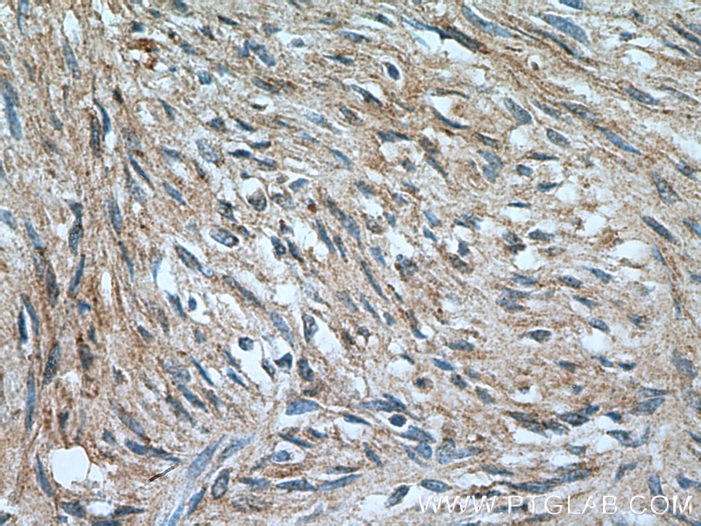 Immunohistochemistry (IHC) staining of human hysteromyoma tissue using SMTN Polyclonal antibody (23567-1-AP)