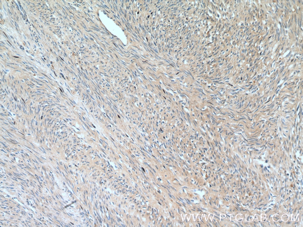 Immunohistochemistry (IHC) staining of human hysteromyoma tissue using SMTN Polyclonal antibody (23567-1-AP)