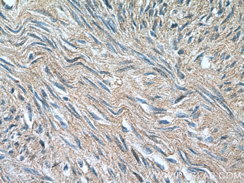Immunohistochemistry (IHC) staining of human hysteromyoma tissue using SMTN Polyclonal antibody (23567-1-AP)