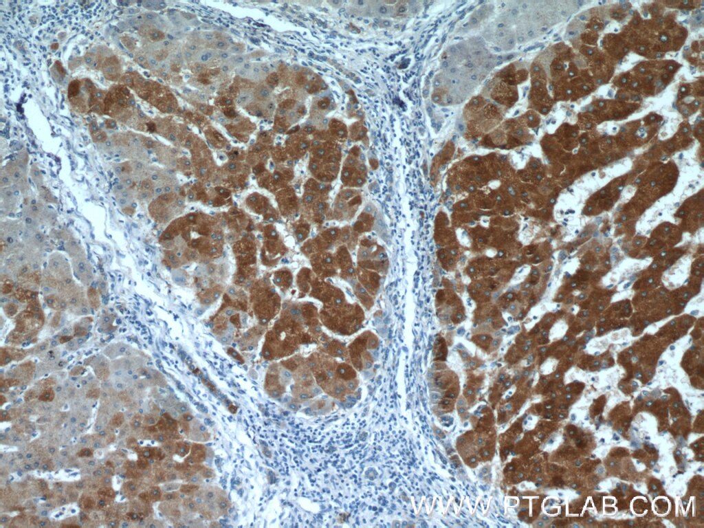 Immunohistochemistry (IHC) staining of human hepatocirrhosis tissue using SMU1 Polyclonal antibody (15511-1-AP)