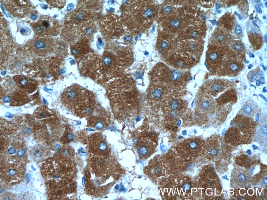 Immunohistochemistry (IHC) staining of human hepatocirrhosis tissue using SMU1 Polyclonal antibody (15511-1-AP)