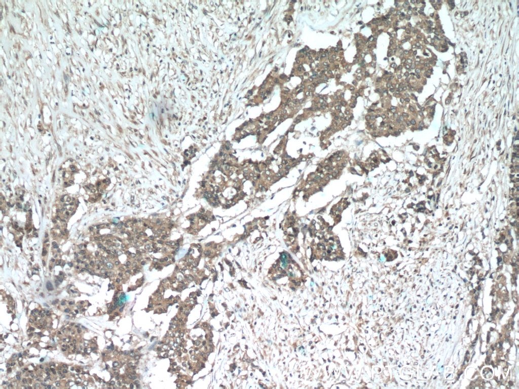Immunohistochemistry (IHC) staining of human colon cancer tissue using SMURF1 Polyclonal antibody (55175-1-AP)