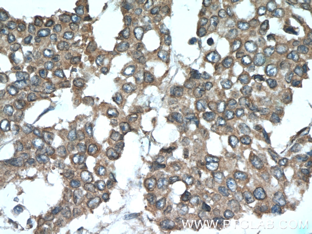 Immunohistochemistry (IHC) staining of human colon cancer tissue using SMURF1 Polyclonal antibody (55175-1-AP)