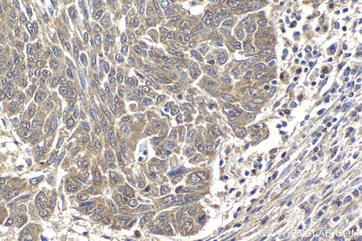 Immunohistochemistry (IHC) staining of human lung cancer tissue using SMURF2 Polyclonal antibody (18038-1-AP)