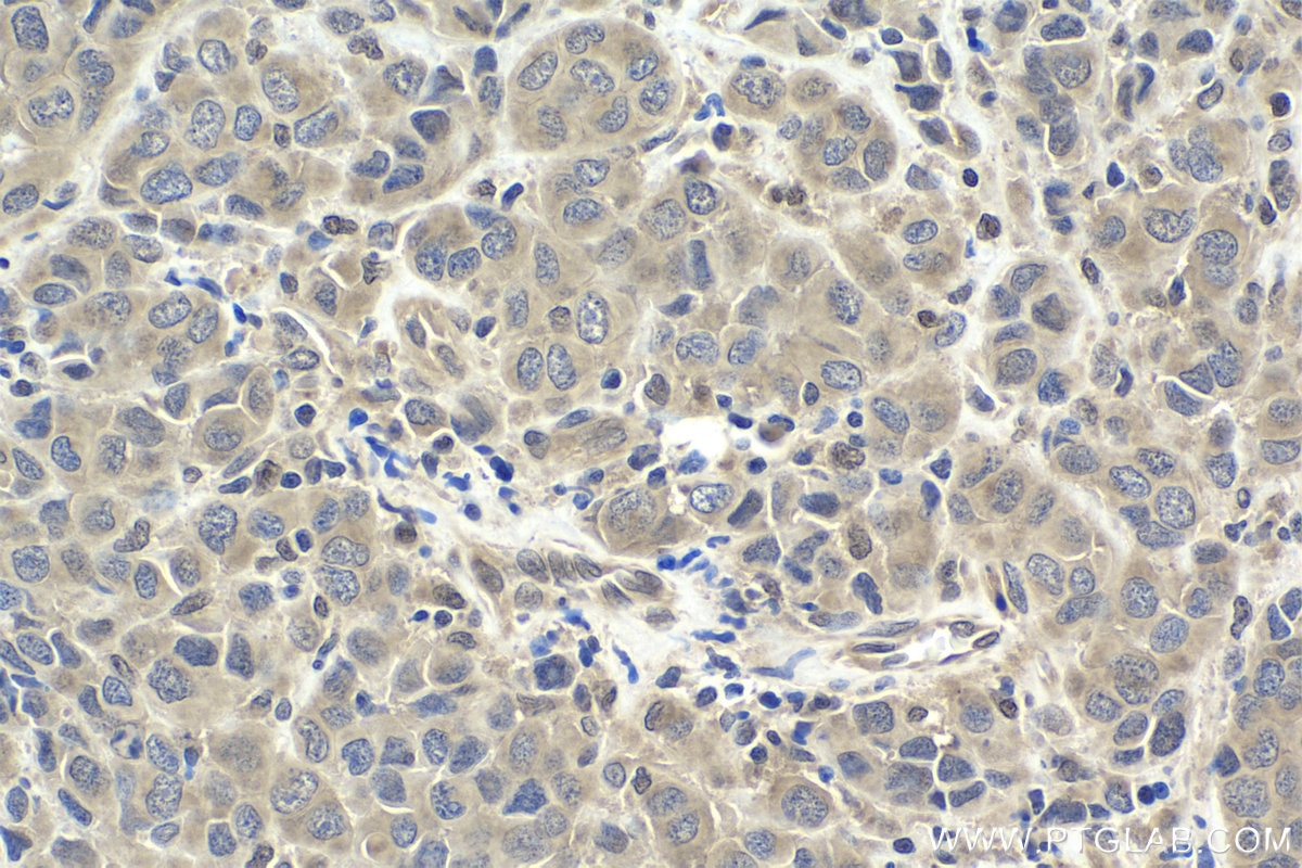 Immunohistochemistry (IHC) staining of human malignant melanoma tissue using SMURF2 Polyclonal antibody (18038-1-AP)