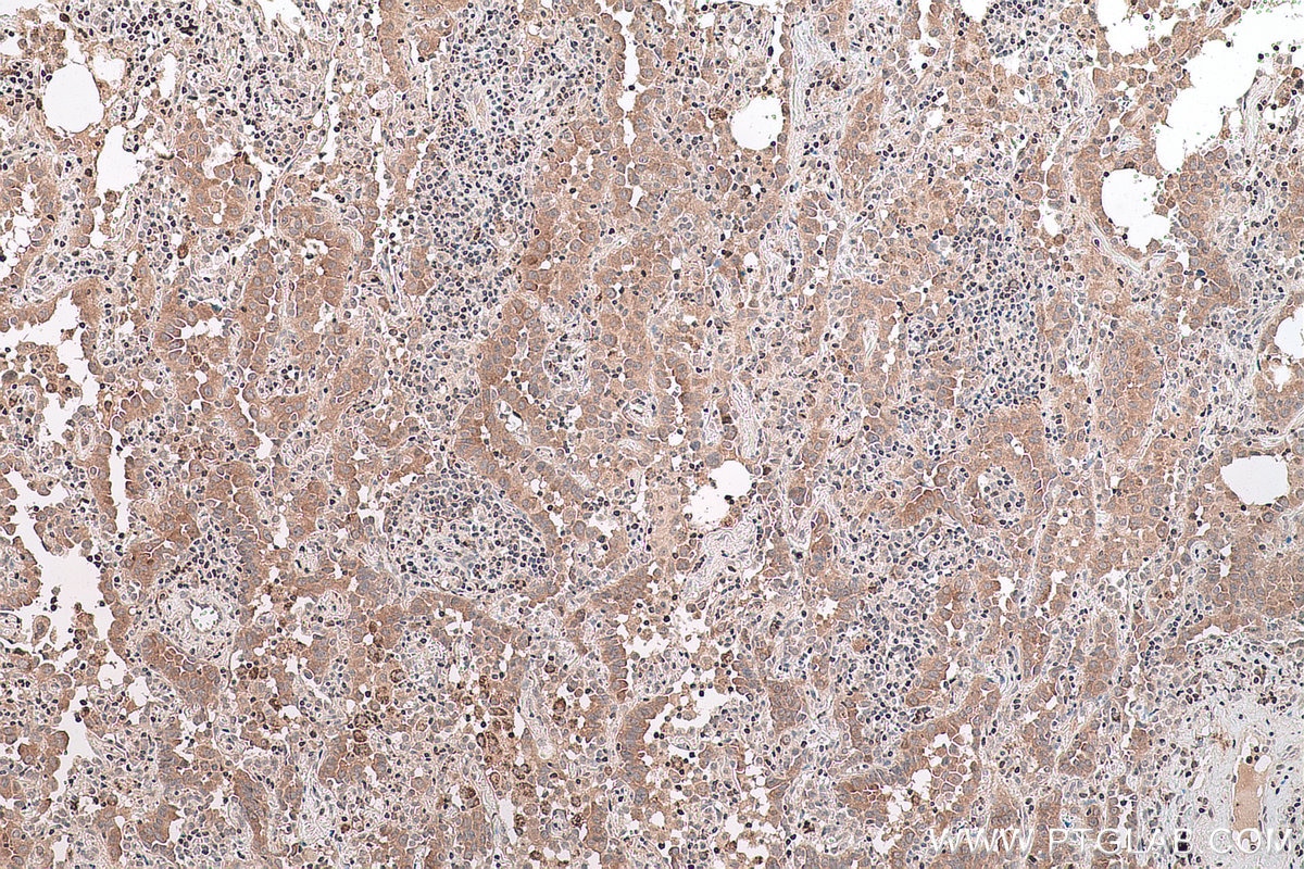 Immunohistochemistry (IHC) staining of human lung cancer tissue using SMYD2 Polyclonal antibody (21290-1-AP)