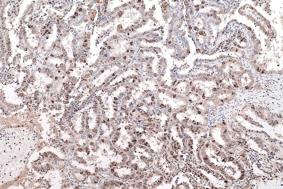 Immunohistochemistry (IHC) staining of human ovary tumor tissue using SMYD2 Polyclonal antibody (21290-1-AP)