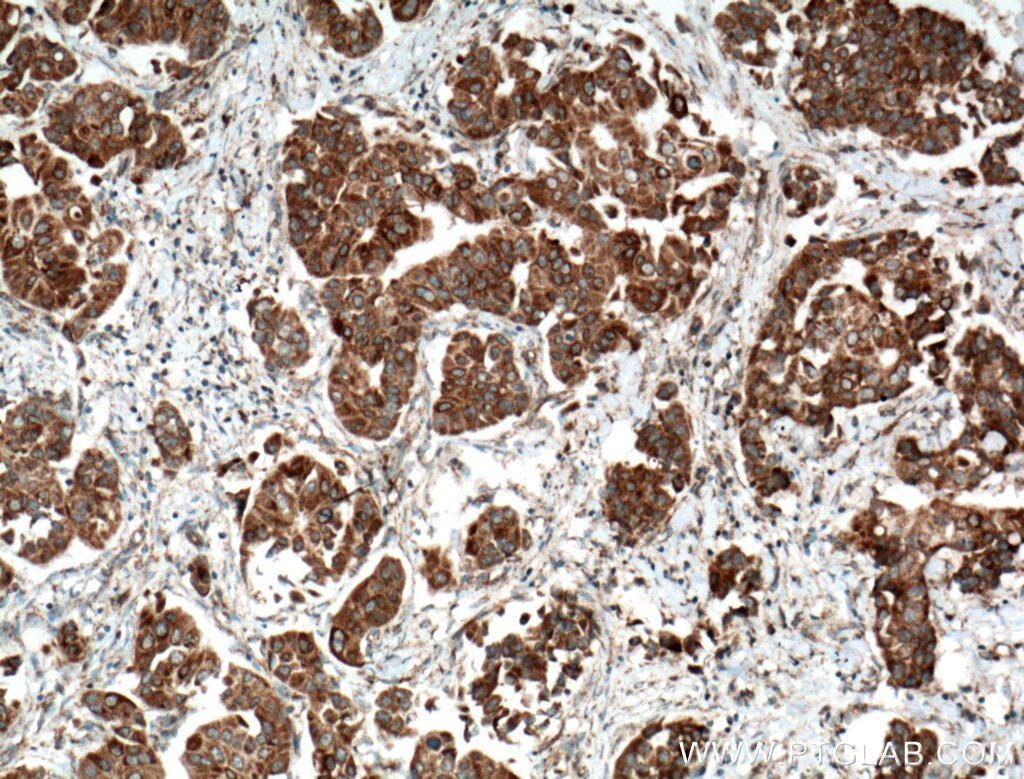 Immunohistochemistry (IHC) staining of human breast cancer tissue using SMYD3 Polyclonal antibody (12011-1-AP)