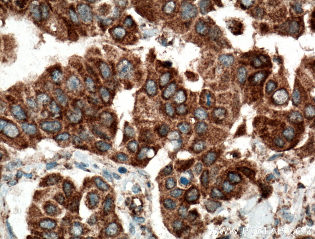 Immunohistochemistry (IHC) staining of human breast cancer tissue using SMYD3 Polyclonal antibody (12011-1-AP)