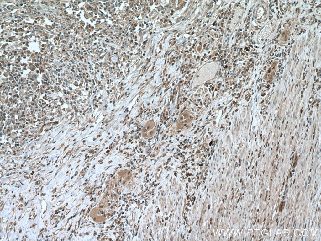 IHC staining of human colon cancer using 12011-1-AP