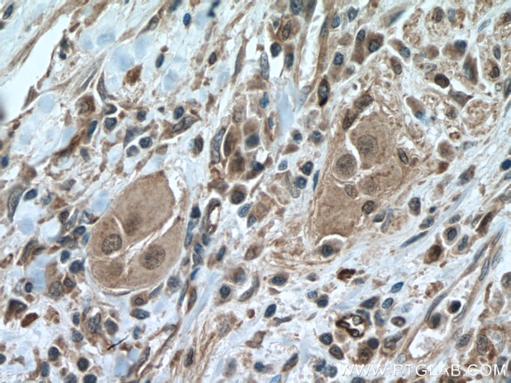 Immunohistochemistry (IHC) staining of human colon cancer tissue using SMYD3 Polyclonal antibody (12011-1-AP)
