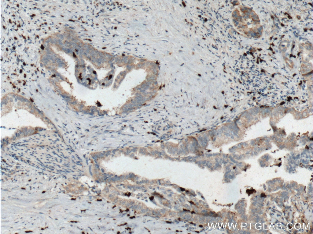 Immunohistochemistry (IHC) staining of human pancreas cancer tissue using SMYD3 Monoclonal antibody (66330-1-Ig)