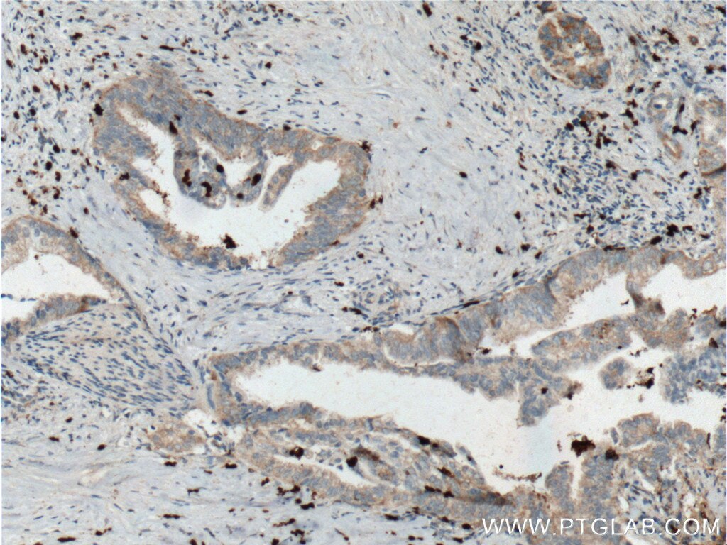 IHC staining of human pancreas cancer using 66330-1-Ig