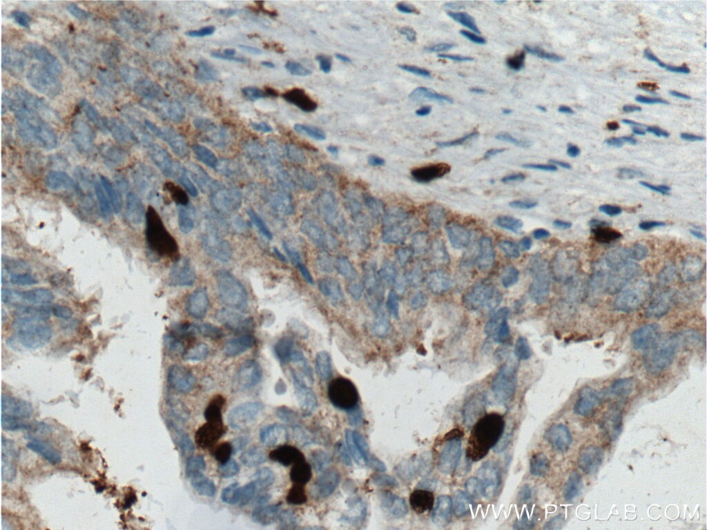 Immunohistochemistry (IHC) staining of human pancreas cancer tissue using SMYD3 Monoclonal antibody (66330-1-Ig)