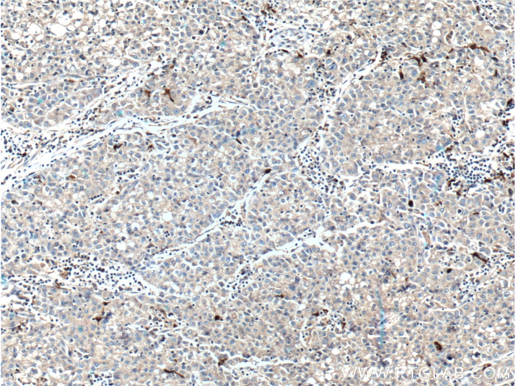 IHC staining of human liver cancer using 66330-1-Ig