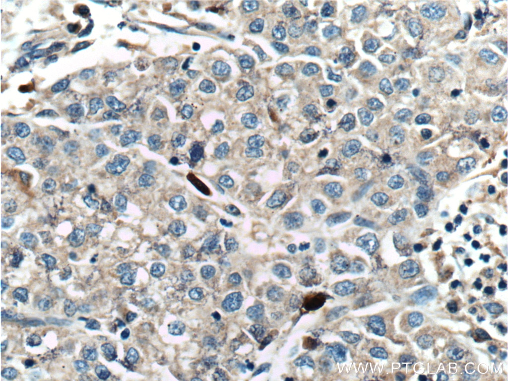 Immunohistochemistry (IHC) staining of human liver cancer tissue using SMYD3 Monoclonal antibody (66330-1-Ig)