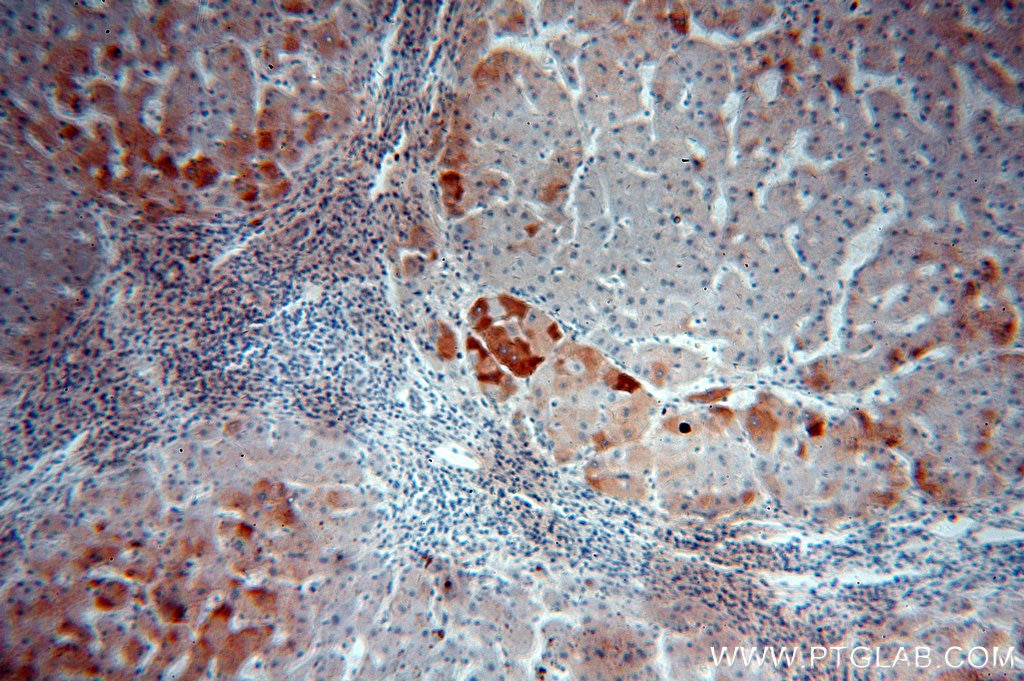 Immunohistochemistry (IHC) staining of human hepatocirrhosis tissue using SMYD4 Polyclonal antibody (17594-1-AP)