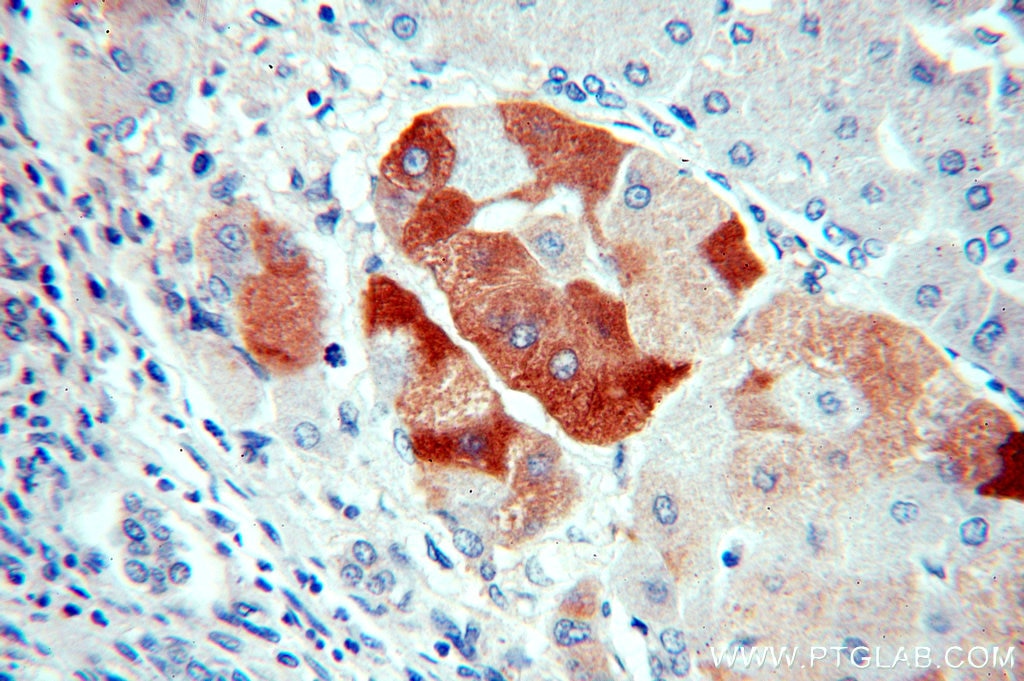 Immunohistochemistry (IHC) staining of human hepatocirrhosis tissue using SMYD4 Polyclonal antibody (17594-1-AP)
