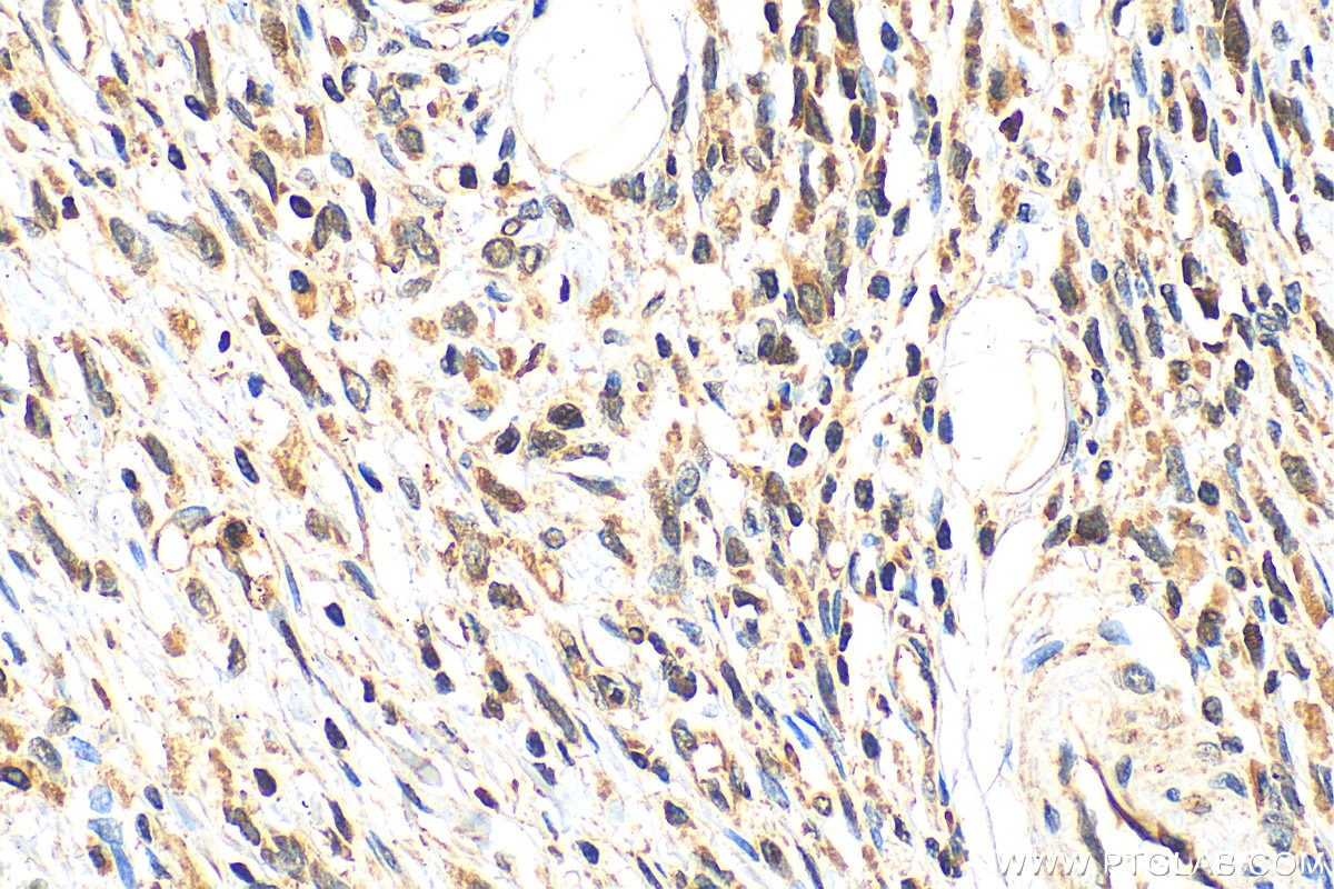 Immunohistochemistry (IHC) staining of human stomach cancer tissue using SNAI1 Polyclonal antibody (13099-1-AP)