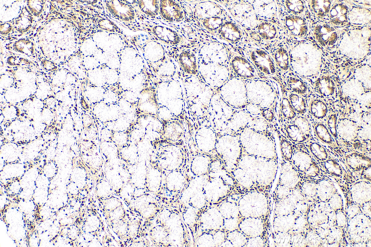 Immunohistochemistry (IHC) staining of human stomach cancer tissue using SNAI1 Polyclonal antibody (13099-1-AP)