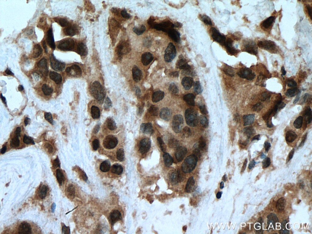 IHC staining of human breast cancer using 12129-1-AP