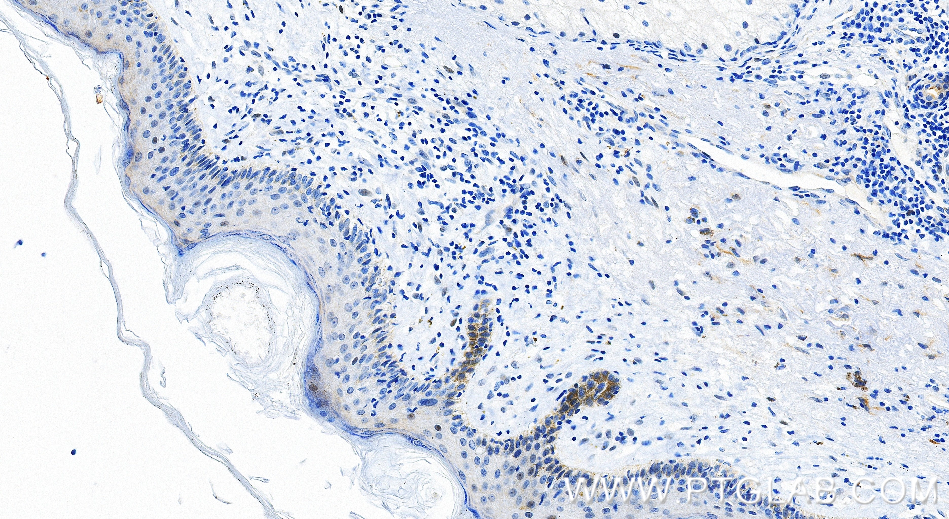 IHC staining of human skin using 82755-3-RR Immunohistochemistry (IHC) staining of human skin tissue using SNAI2/SLUG Recombinant monoclonal antibody (82755-3-RR)