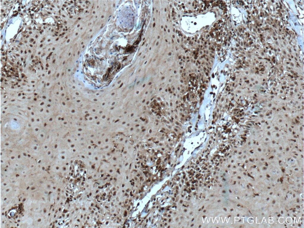 Immunohistochemistry (IHC) staining of human skin cancer tissue using SNAI3 Polyclonal antibody (21350-1-AP)