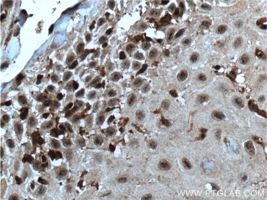 Immunohistochemistry (IHC) staining of human skin cancer tissue using SNAI3 Polyclonal antibody (21350-1-AP)