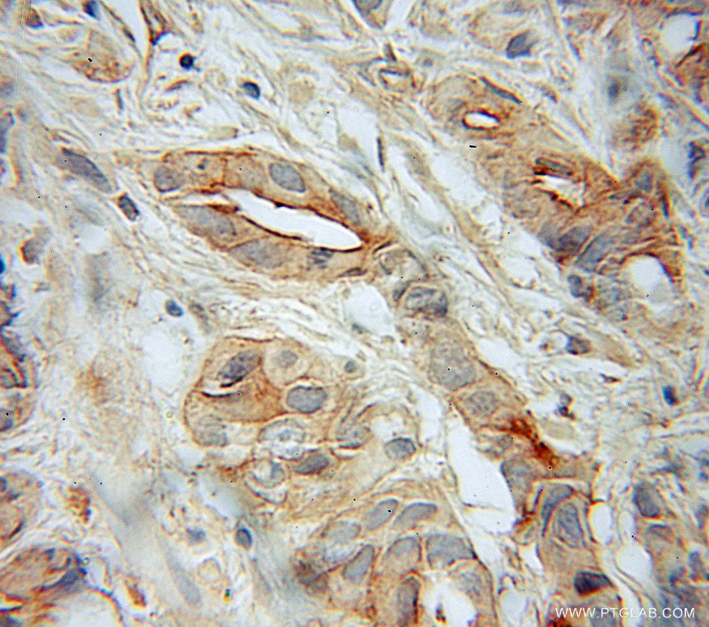 Immunohistochemistry (IHC) staining of human prostate cancer tissue using SNAP23 Polyclonal antibody (10825-1-AP)