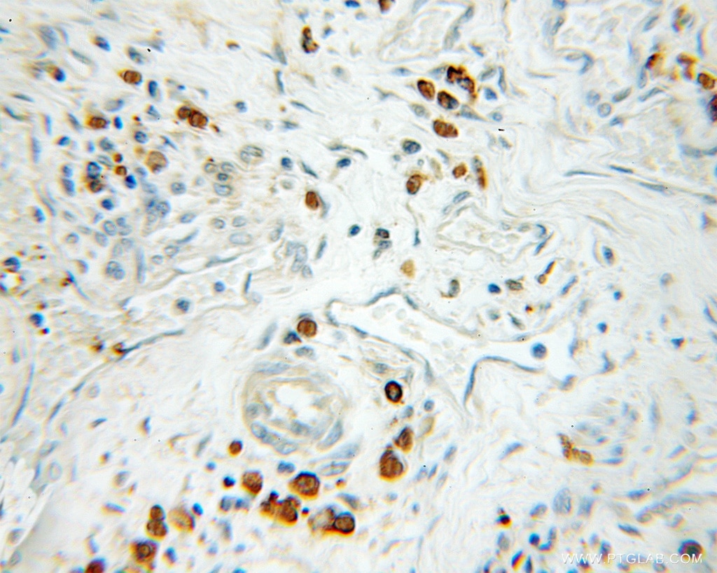 Immunohistochemistry (IHC) staining of human colon cancer tissue using SNAPC1 Polyclonal antibody (11297-1-AP)